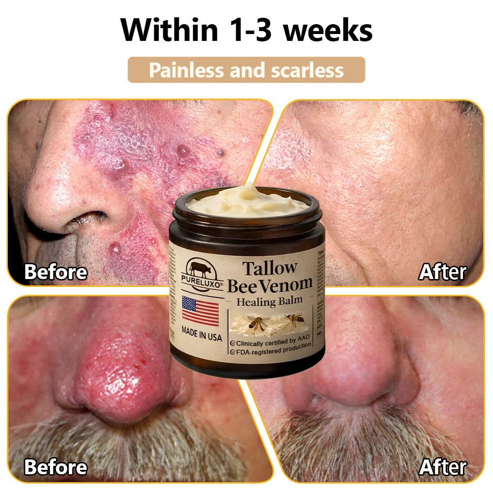 【80% OFF Ends Today】Pureluxo® 🐄Tallow Bee Venom Healing Balm（Targets Bumps, Wrinkles & Stressed Skin — Without Steroids）