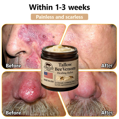 【80% OFF Ends Today】Pureluxo® 🐄Tallow Bee Venom Healing Balm（Targets Bumps, Wrinkles & Stressed Skin — Without Steroids）