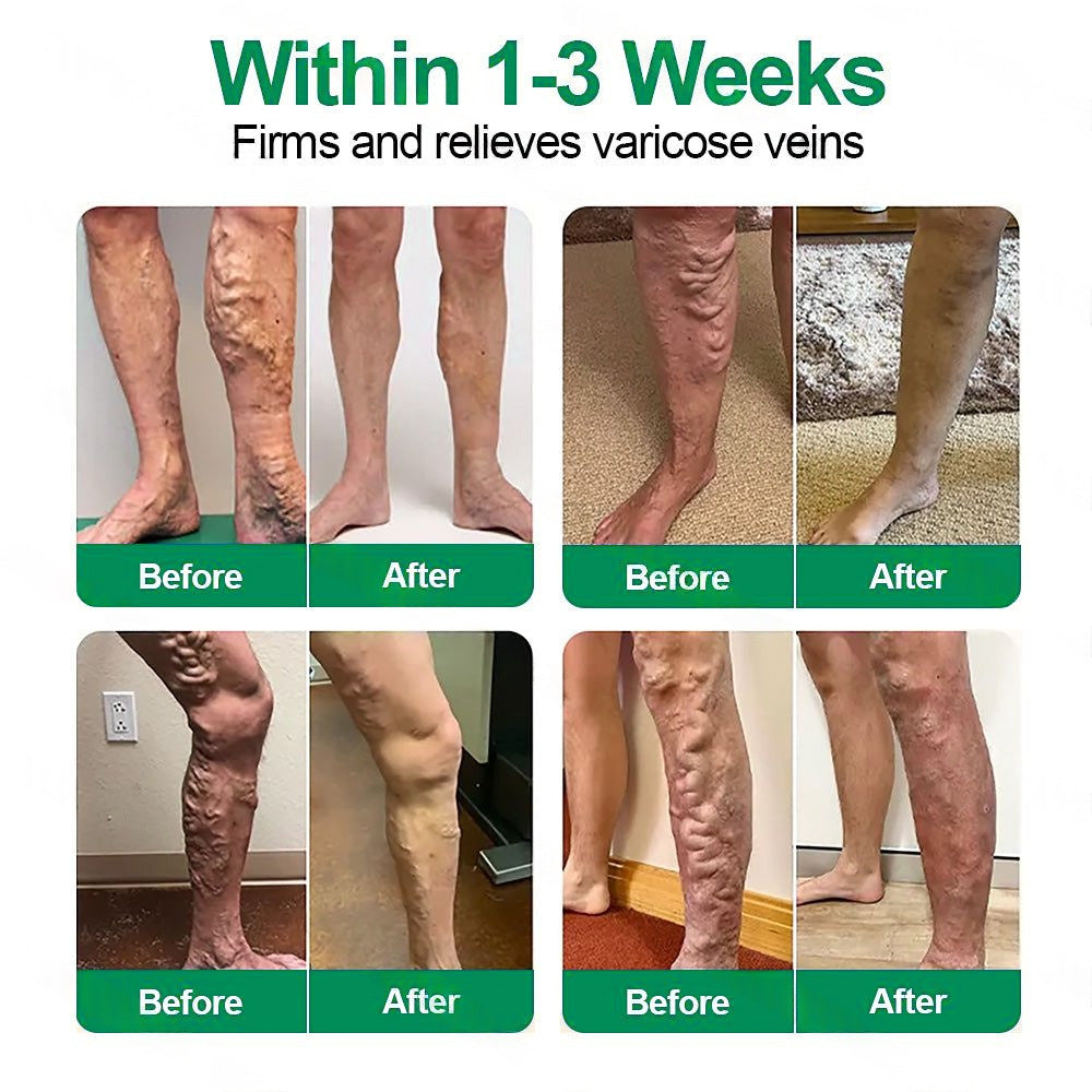 🇺🇸[FDA-Registered & GMP Certified]| 𝙋𝙪𝙧𝙚𝙡𝙪𝙭𝙤® VeinTarget Microneedle Patch⚡Instant Relief, Long-Term Results