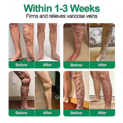 🇺🇸[FDA-Registered & GMP Certified]| 𝙋𝙪𝙧𝙚𝙡𝙪𝙭𝙤® VeinTarget Microneedle Patch⚡Instant Relief, Long-Term Results