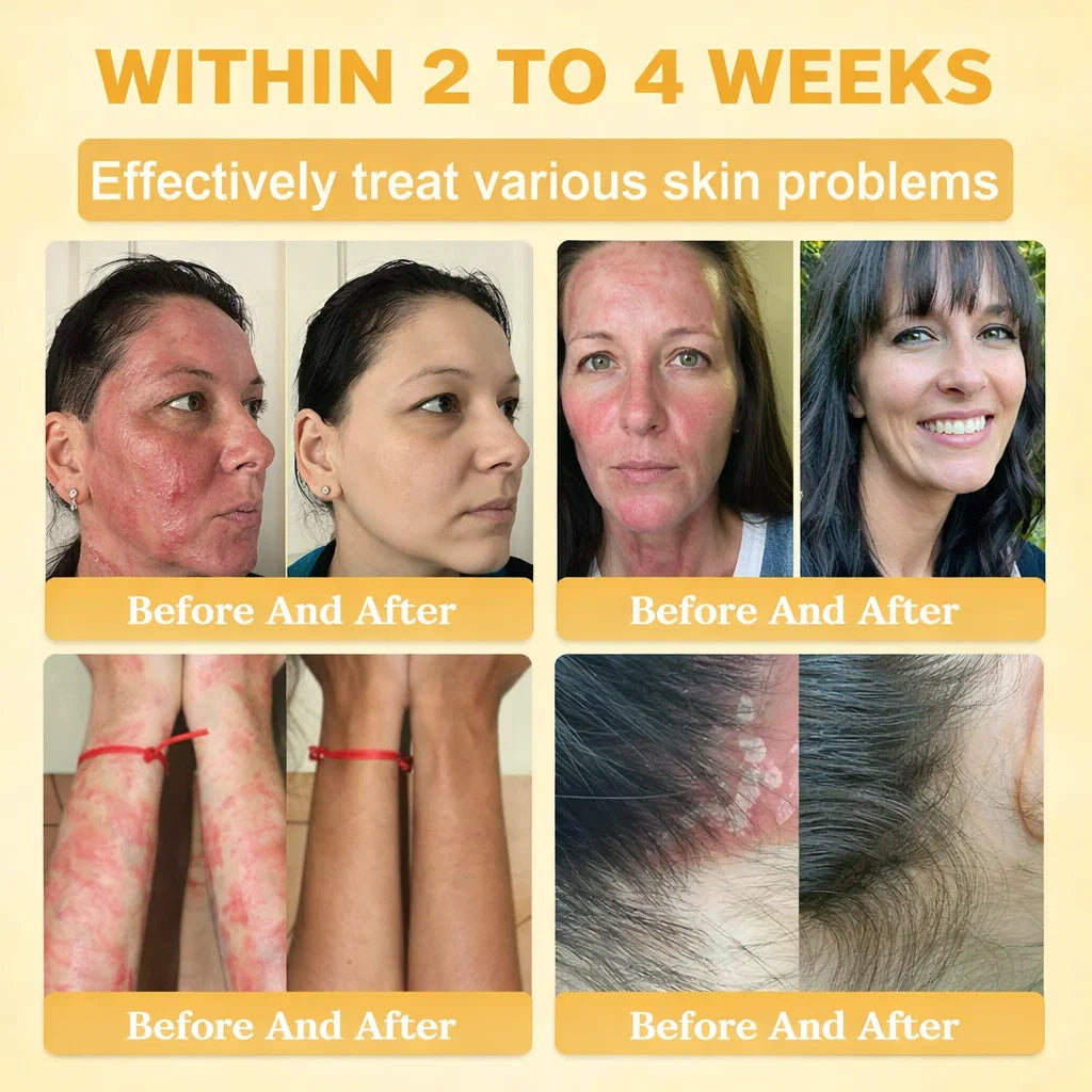 【70% OFF Ends Today】Pureluxo® 🐄Tallow Bee Venom Healing Balm（Targets Bumps, Wrinkles & Stressed Skin — Without Steroids）